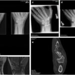 Scaphoid Fracture Diagnosis