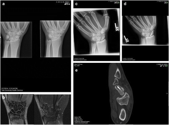 Scaphoid Fracture Diagnosis