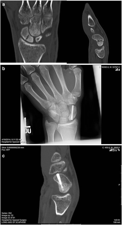 Scaphoid Fracture Treatment