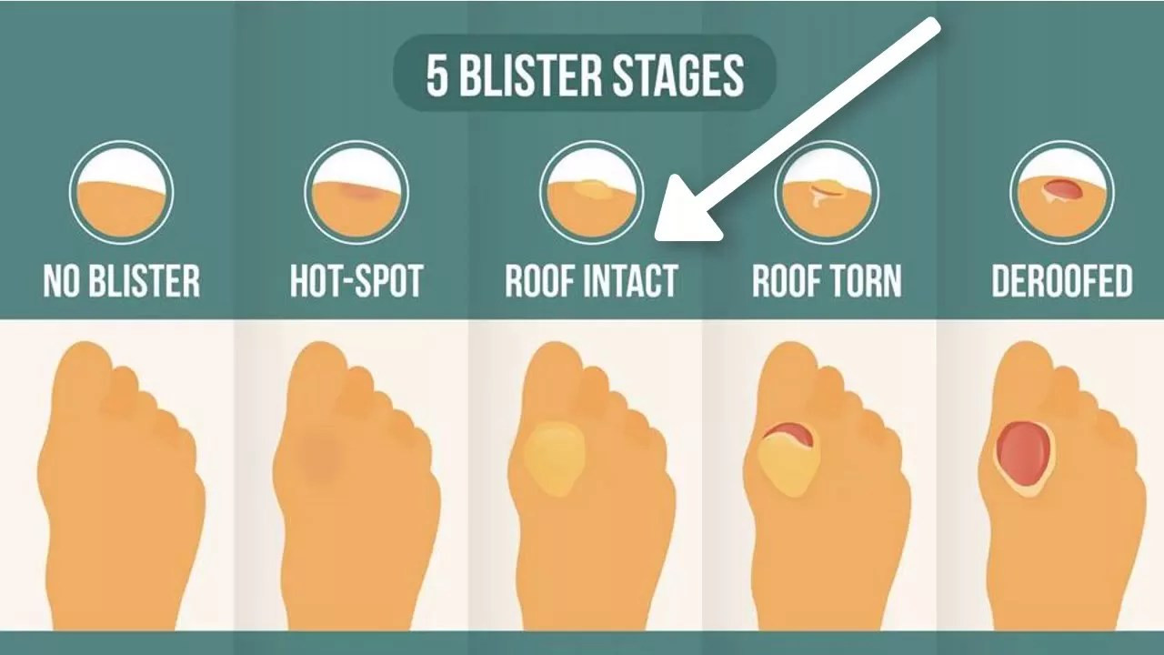 Football Blisters