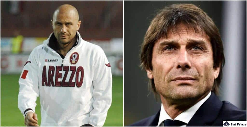Antonio Conte's hair transplant journey