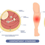 Picture Showing Compartment Syndrome