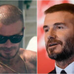 David Beckham had a footballer hair transplant shortly after his retirement