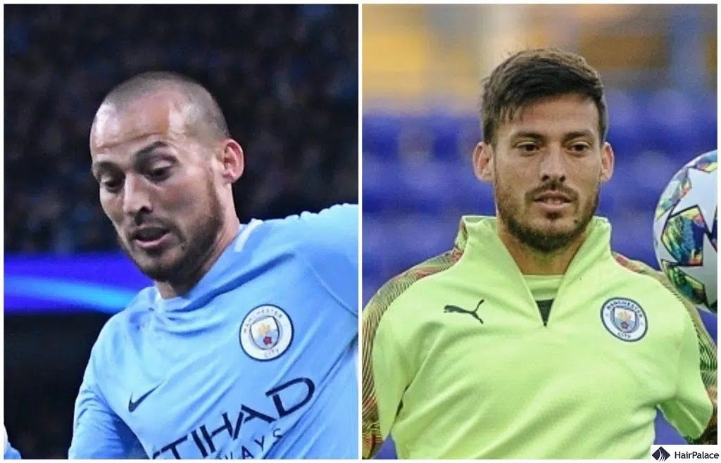 David Silva showing off his new hairline