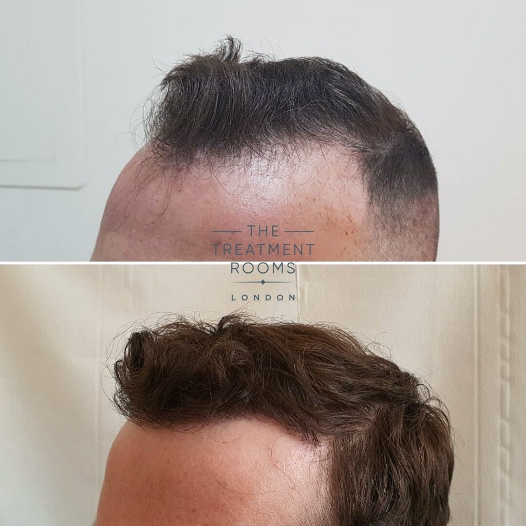 light exercise after hair transplant