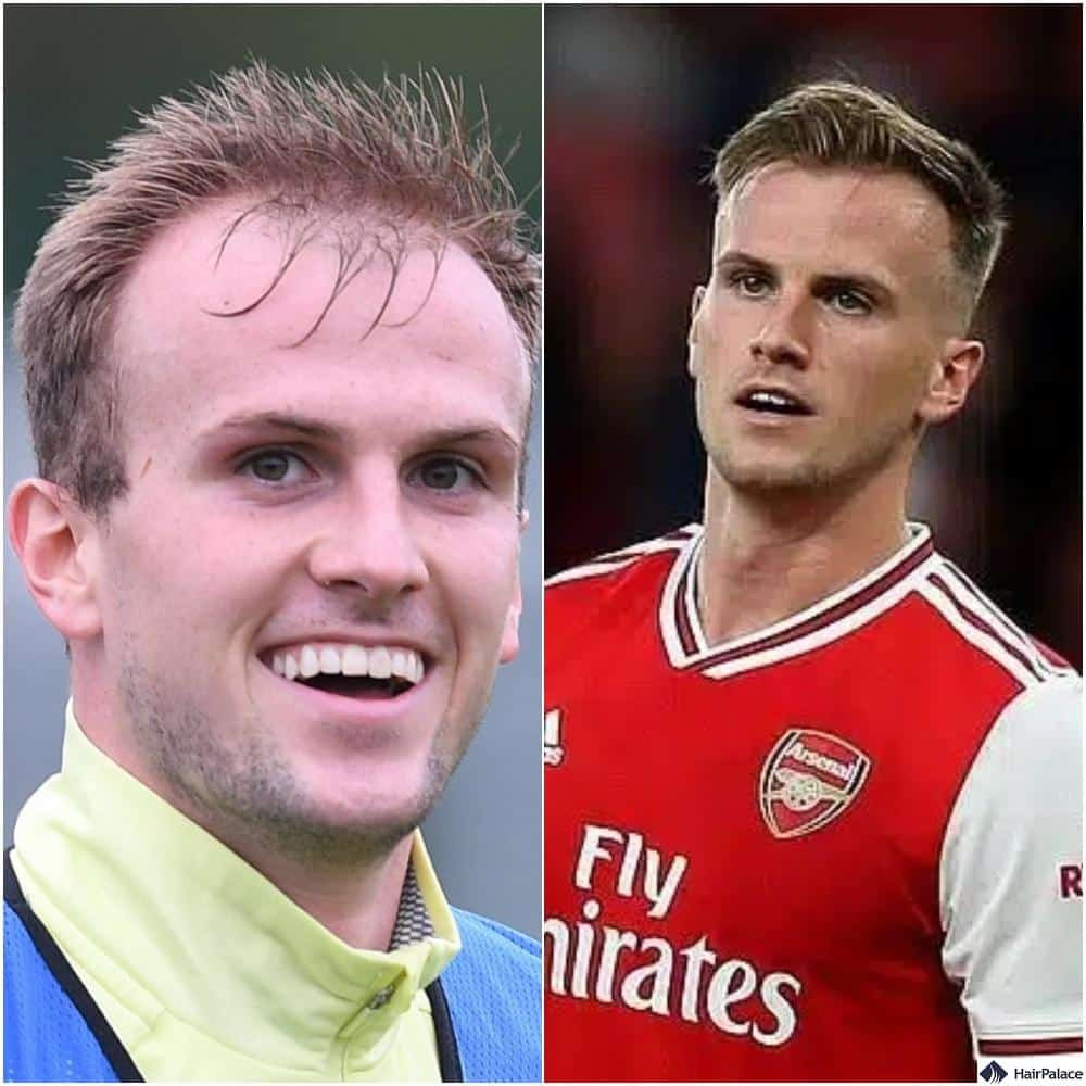 Rob Holding's before and after hair transplant photos