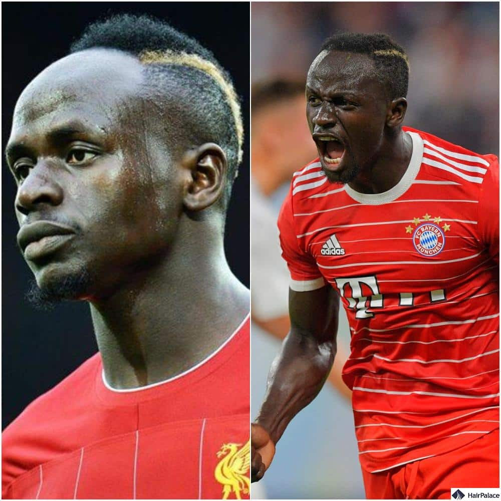 did Sadio Mane haive a hair transplant?